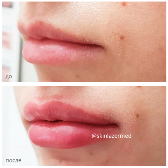 Коррекция губ Juvederm Ultra 3 Милокостова Ю.А