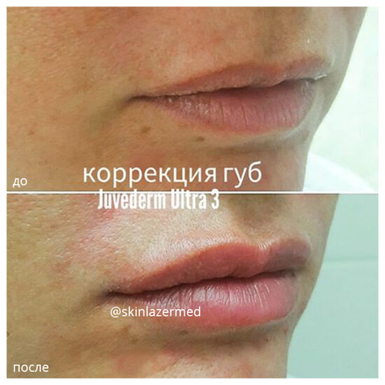 контурная пластика губ Juvederm Ultra 3 милокостова