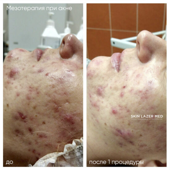 Мезотерапия акне ADN Restart Immuno Асанова Э.Н