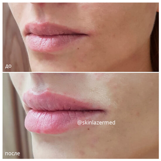 коррекция форму губ милокостова ю.а. Juvederm ultra 3