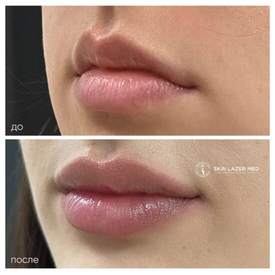 Контурная пластика губ Juvederm Ultra Smile. Иванчик А.А.