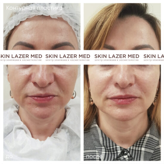 коррекция средней трети лица Juvederm Volume и Juvederm Ultra 3 Милокостова Ю.А.