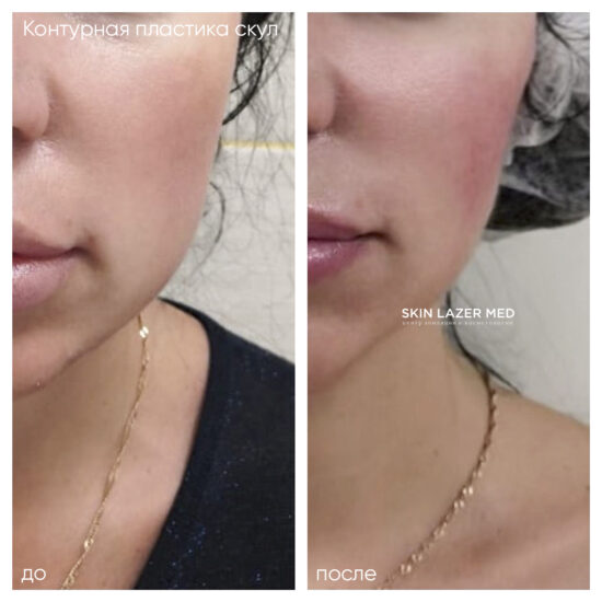 контурная пластика скул Juvederm Volume Лужанская Ю.В.