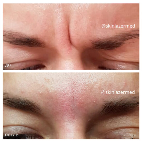 Ботокс 12 ед., Juvederm Ultra 3 - 1мл. милокостова