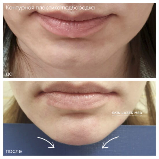 Коррекция области подбородка juvederm volume Милокостова Ю.А.