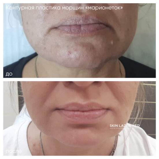 Коррекция морщин марионеток в уголках губ Врач Стасилевич Т.И. Juvederm Ultra 3