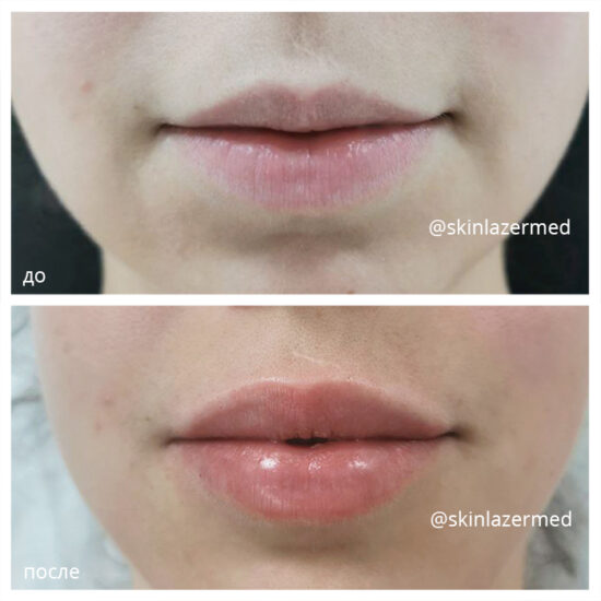 контурная пластика губ Belotero Lips Shape Милокостова