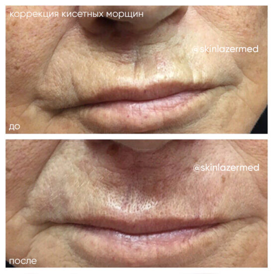 Кистетные морщины. Препарат Juvederm 3, 1 мл. Первый этап коррекции кисетных морщин вокруг рта. Врач Сухиасян Р.Н.