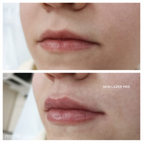 контурная пластика губ Минина Belotero Lips Shape