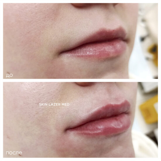 контурная пластика губ Минина Belotero Lips Shape