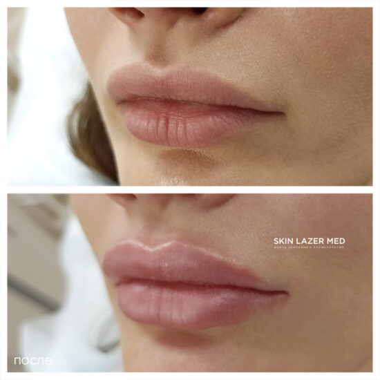 контурная пластика губ Минина Инна Сергеевна Belotero Lips Shape