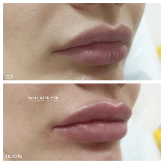 контурная пластика губ Минина Инна Сергеевна Belotero Lips Shape