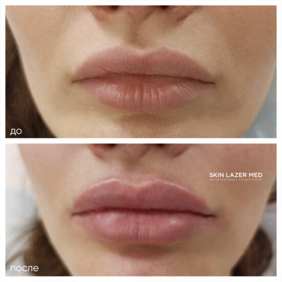 контурная пластика губ Минина Инна Сергеевна Belotero Lips Shape