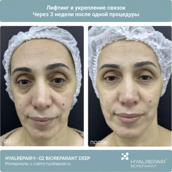 биорепарация HYALREPAIR®-02 deep