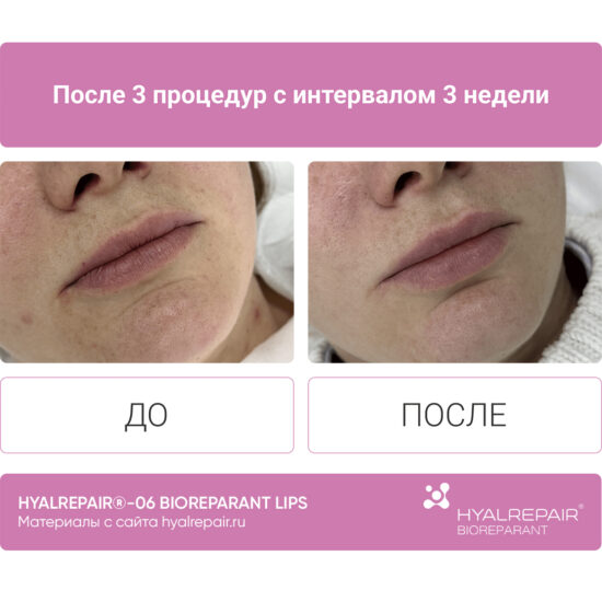 биорепарация HYALREPAIR®-06 lips