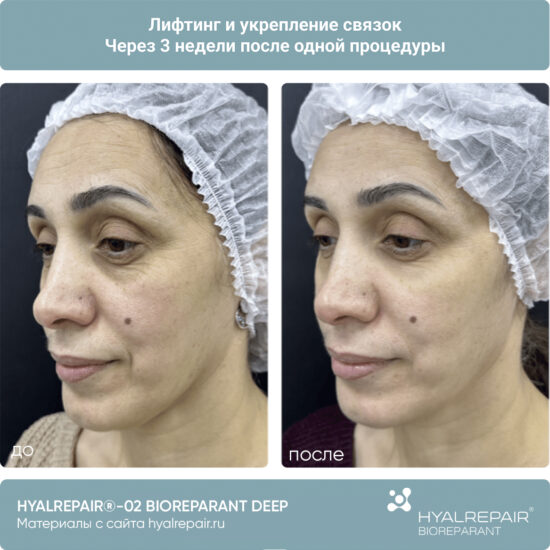 биорепарация HYALREPAIR®-02 deep