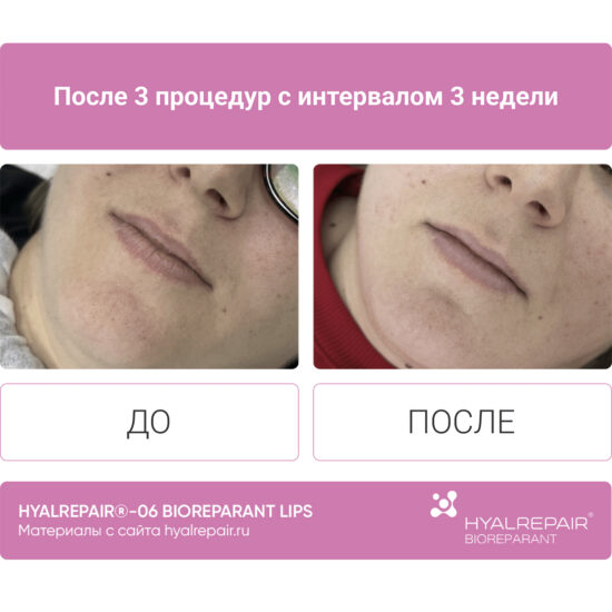 биорепарация HYALREPAIR®-06 lips