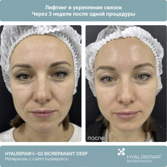 биорепарация HYALREPAIR®-02 deep