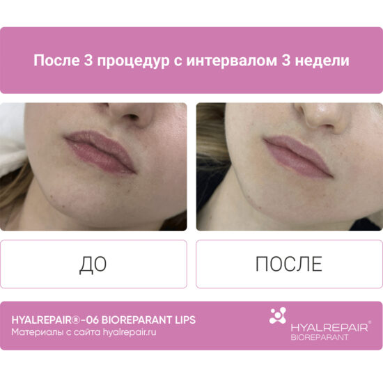 биорепарация HYALREPAIR®-06 lips