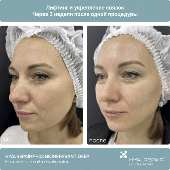 биорепарация HYALREPAIR®-02 deep