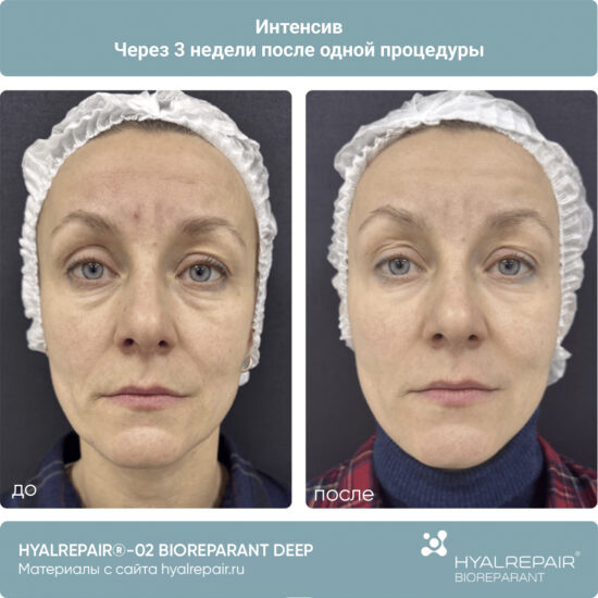 биорепарация HYALREPAIR®-02 deep