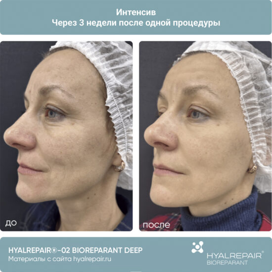 биорепарация HYALREPAIR®-02 deep