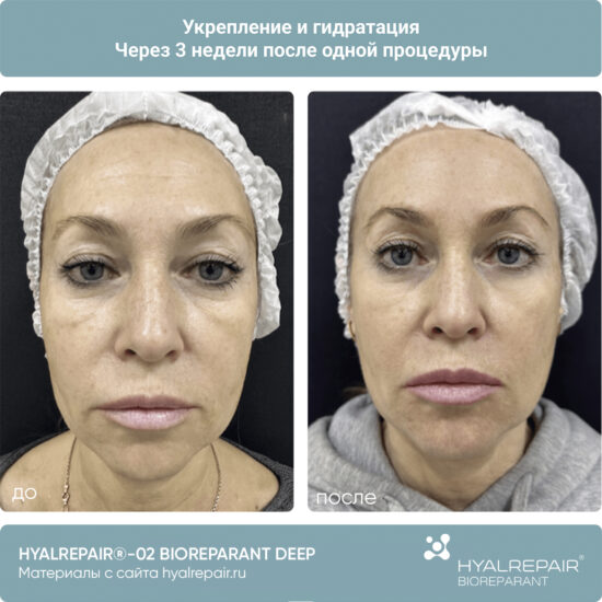 биорепарация HYALREPAIR®-02 deep