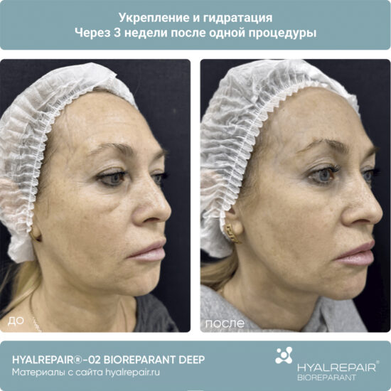 биорепарация HYALREPAIR®-02 deep