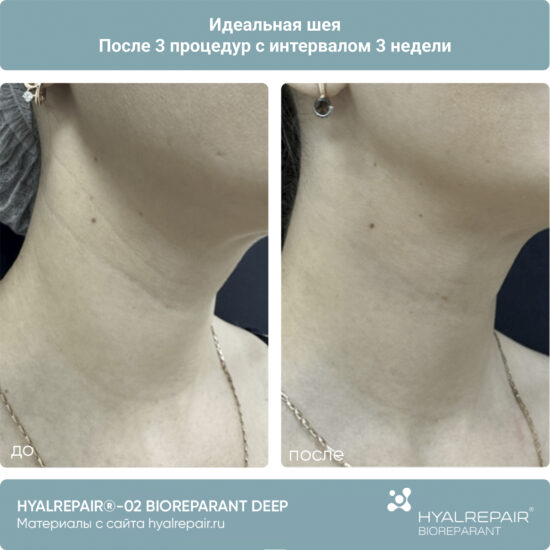 биорепарация HYALREPAIR®-02 deep